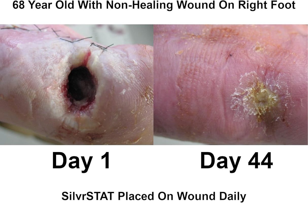 ABL Medical SilvrSTAT Silver Gel Dressing, 1 oz.