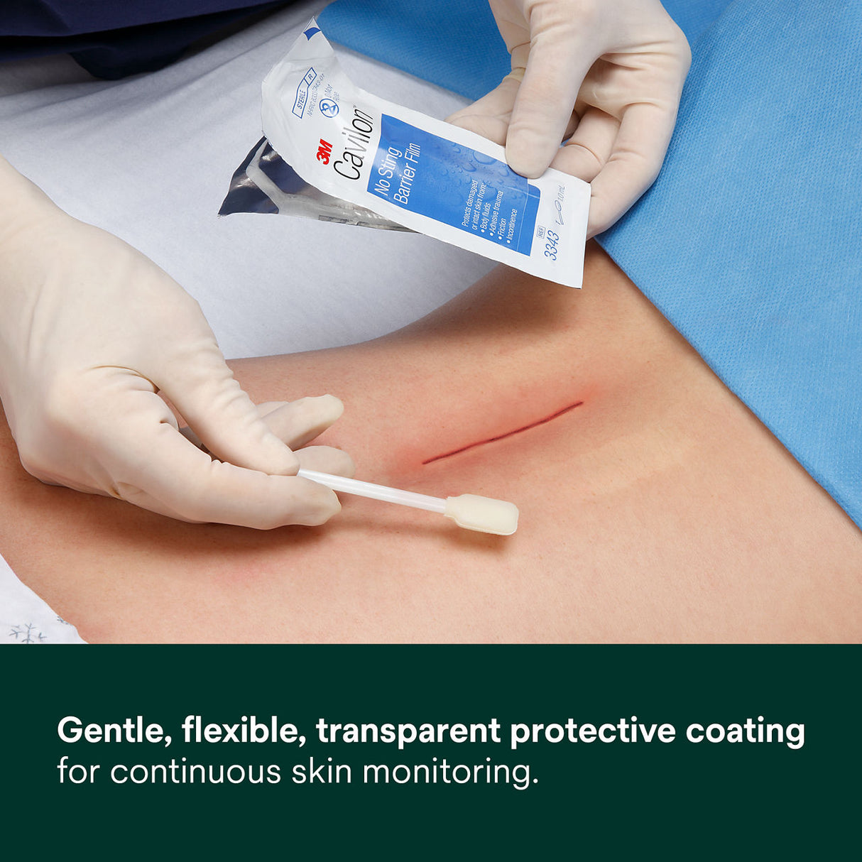 A gloved person uses 3M Cavilon No Sting Barrier Film to clean a surgical incision on a patient’s lower back. Caption: “Gentle, flexible, transparent skin protection for continuous monitoring.”.