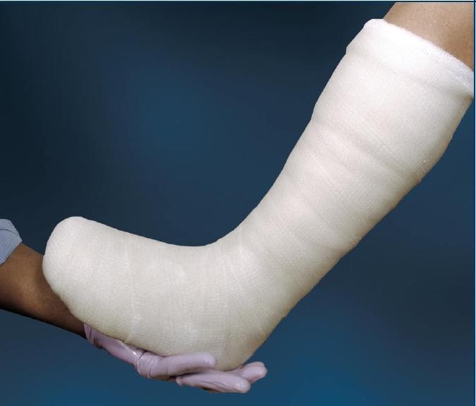 Cutimed Off-Loader Select, Total Contact Cast System, Cotton, Elastic, Felt, Fiberglass, Foam, Plaster of Paris, Stockinette, White - 7800901-Single - LL Medico