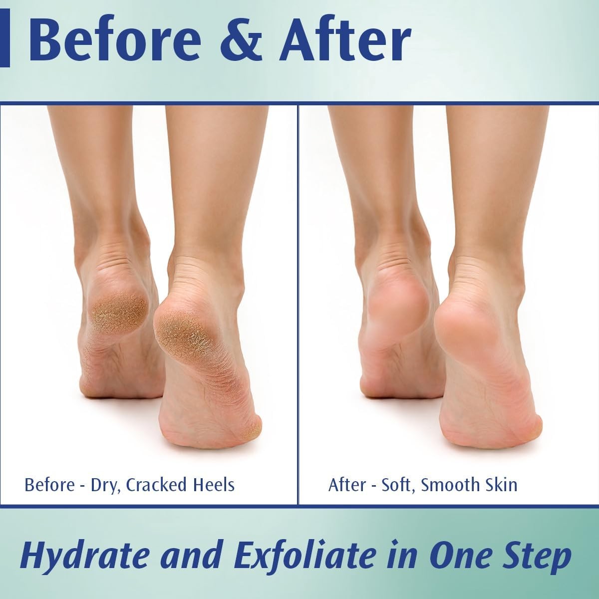 PediFix Callus Control Cream, 20% Urea Formula, 4 oz