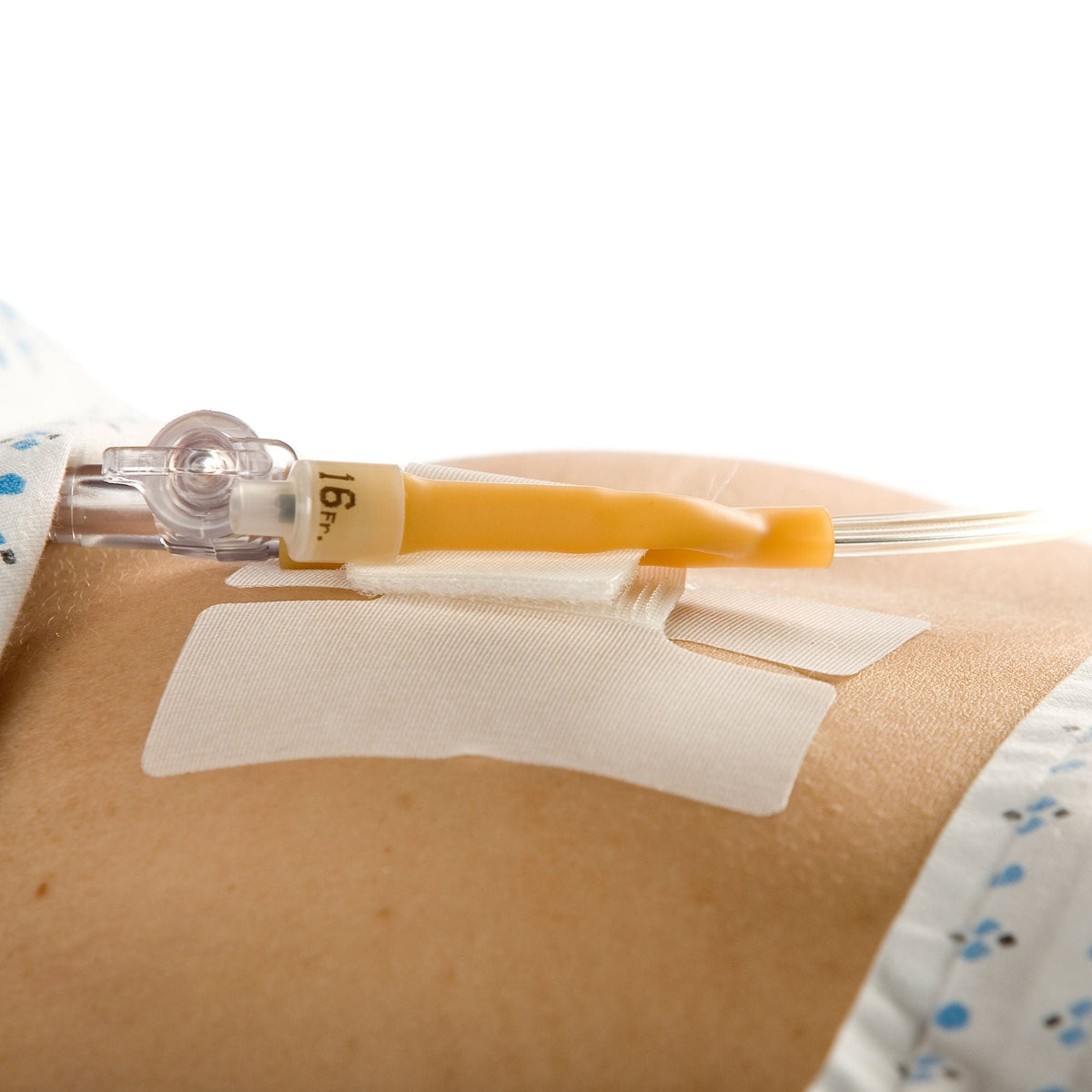 Cath-Secure Tube Holder, Single Hook and Loop Tab, Hypoallergenic, Butterfly Design - 5445-2 - LL Medico