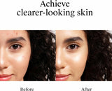 Neutrogena Rapid Clear Stubborn Acne Spot Gel, Maximum Strength, 1 oz
