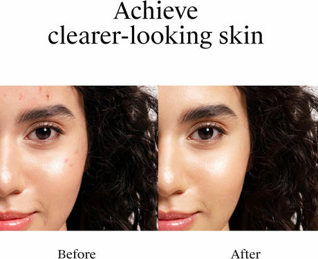 Neutrogena Rapid Clear Stubborn Acne Spot Gel, Maximum Strength, 1 oz