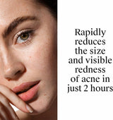 Neutrogena Rapid Clear Stubborn Acne Spot Gel, Maximum Strength, 1 oz