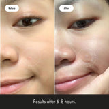 Mighty Patch Acne Treatment
