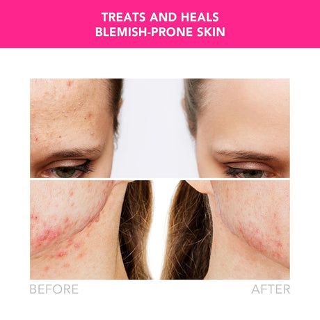 ESPADA 2 Acne Therapy Device, Fuchsia