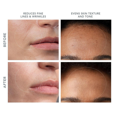 KIWI derma Microdermabrasion Pore Vacuum