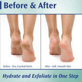 PediFix Callus Control Cream, 20% Urea Formula, 4 oz