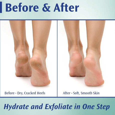 PediFix Callus Control Cream, 20% Urea Formula, 4 oz
