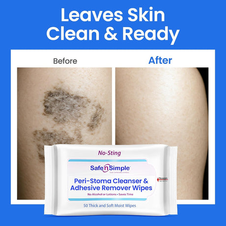 Safe n Simple Adhesive Remover Wipes