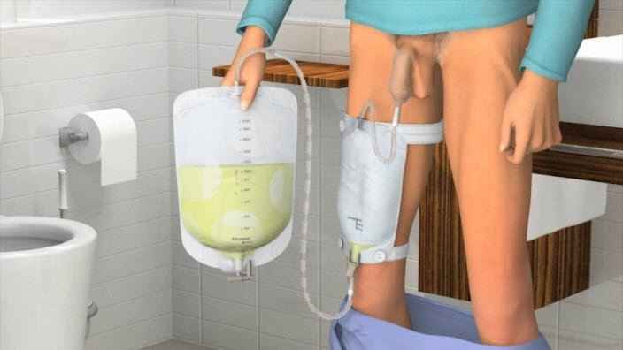 Coloplast Moveen Nighttime Urine Bag - 21346-Single - LL Medico