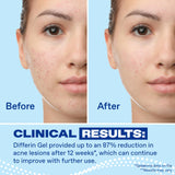 Differin Adapalene Gel 0.1% Acne Treatment