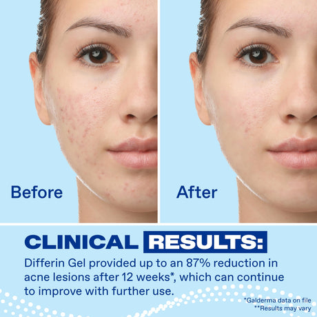 Differin Adapalene Gel 0.1% Acne Treatment