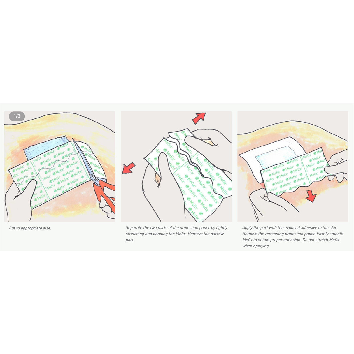 Mefix Nonwoven Dressing Retention Tape, 2 Inch x 11 Yard