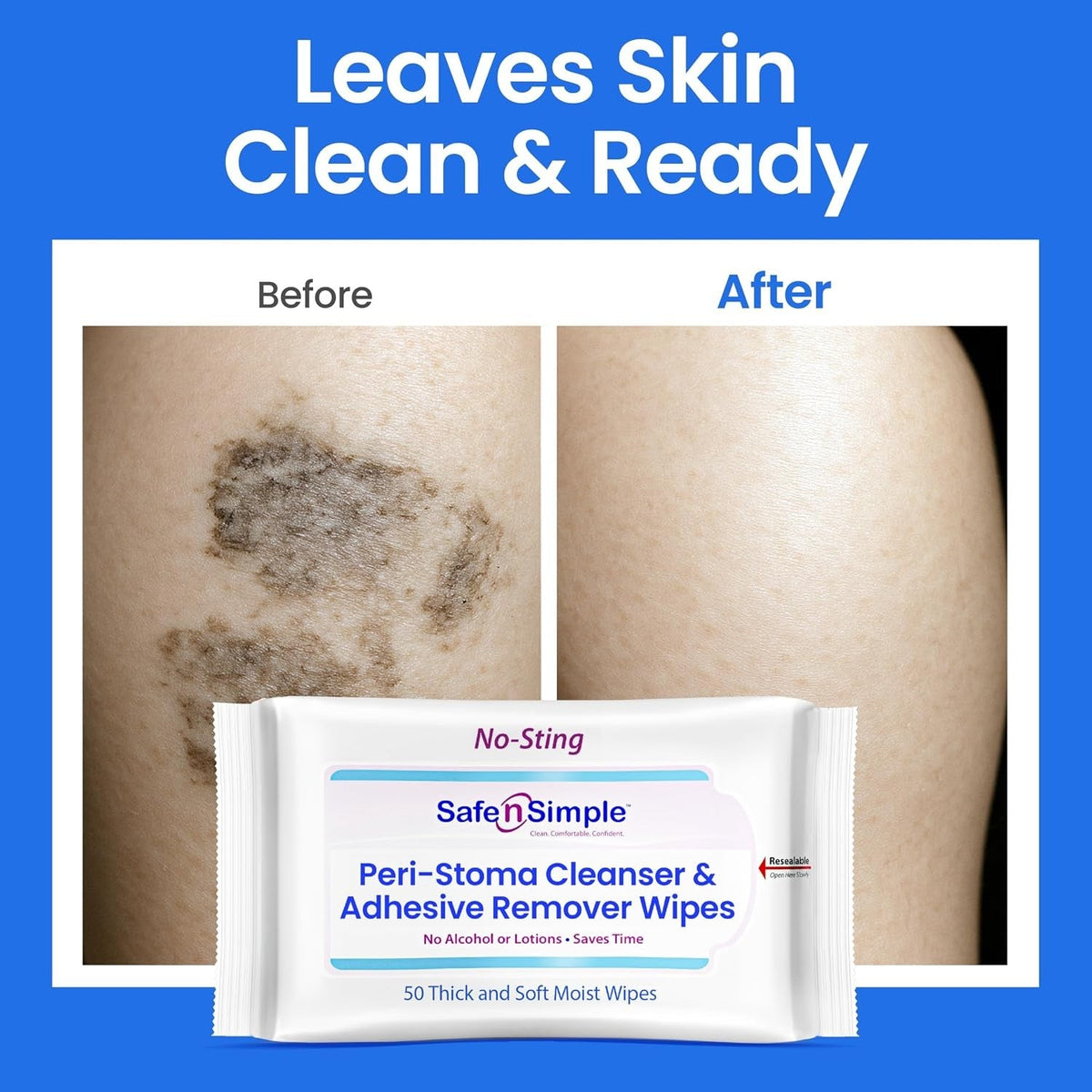 Safe n Simple Peri-Stoma Cleanser & Adhesive Remover Wipes, No-Sting, 5"x7" - SNS00525-Pack - LL Medico